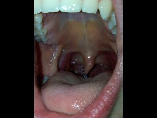 Open Mouth Uvula View