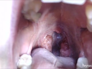 Pre-Op Tonsils PREVIEW - Reyna Mae - BBW Throat Tour Mouth Fetish Uvula Extreme Close Ups Mouth Tour