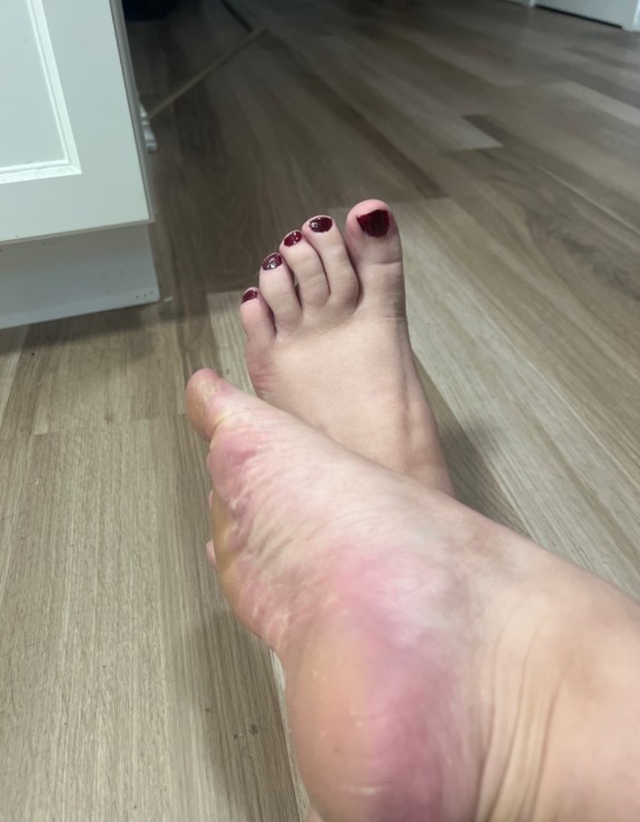 Callous Feet