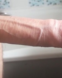 Phimotic cock photo