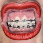Cassy braces