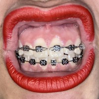 Cassy braces
