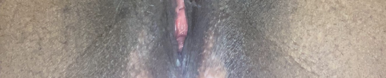 Vitiligopu22y