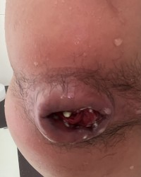 Prolapse photo