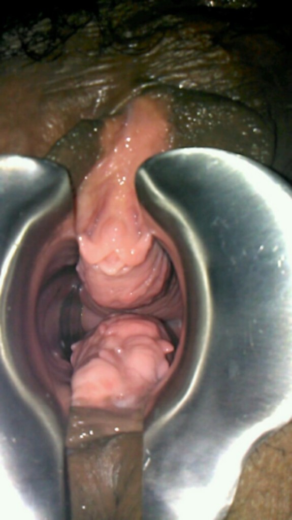 speculum photo