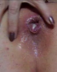 Heart Shaped Box - Anal Prolapse photo
