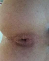 Anal dilatation photo