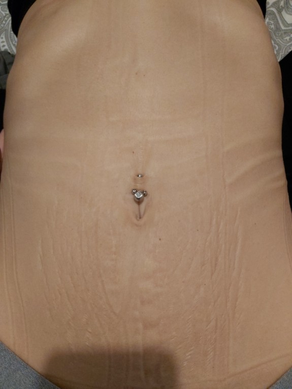 Navel streched 2