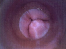 #cervix #endoscope gif