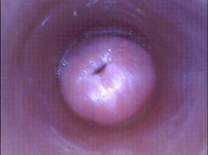 #cervix #endoscope gif