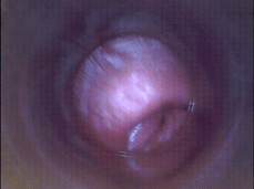Cervix View (EPCV) 1 gif