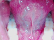 Preview 2 of Tongue, Tonsils, and Throat Examination