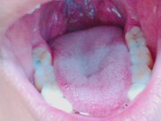 Preview 3 of Tongue, Tonsils, and Throat Examination