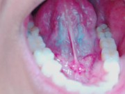 Preview 4 of Tongue, Tonsils, and Throat Examination