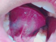 Preview 5 of Tongue, Tonsils, and Throat Examination