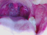 Preview 6 of Tongue, Tonsils, and Throat Examination