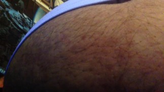 зажим для раздувания живота