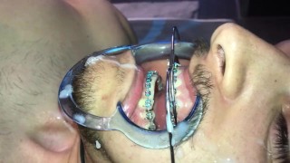 Cuming With Braces On The Head