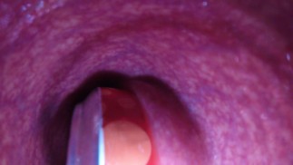 Internal Camera Deep Can Insertion