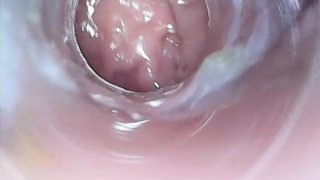 Anal Internal Photography From The Rectum To The S-Shape Using A Micro Camera