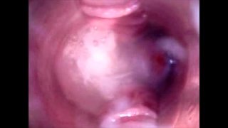2 Spectulum In Pussy And Filmed From Within As It Is Filled With Sperma