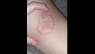 Укус Часть 1