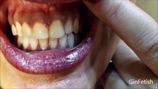 Mouth, uvula, tongue, teeth checks and endoscope thumbnail