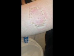 Girl hard biting Marks