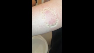 Girl's Severe Bite Marks