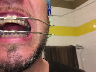 Horny Deepthroat Full of Spit with Braces and Double Headgear
