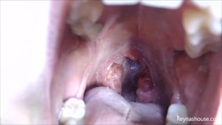 Pre-Op Tonsils PREVIEW - Reyna Mae - BBW Throat Tour Mouth Fetish Uvula Extreme Close Ups Mouth Tour