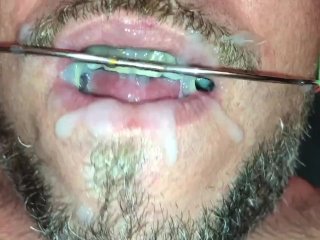 Self facial cumming on braces retainer twinblock with headgear