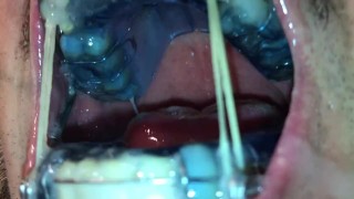 Self facial cumming on braces retainer twinblock with headgear