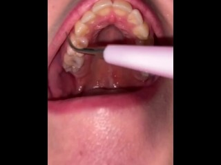 Limpieza Dental Ultrasónica. Fetiche De Dientes.
