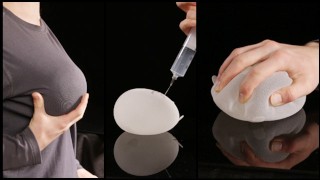 Enchimento gradual de implante de mama expansor com salina em o dobro do seu tamanho prescrito