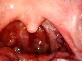 My throat with endoscope