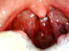 My throat with endoscope