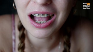 She Attempted To Add As Many Elastics As She Could To The Braces Elastic Challenge