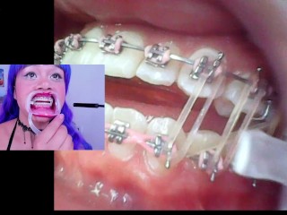 Lila Jordan 歯科矯正とサスペンダー