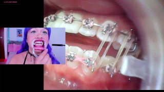 Lila Jordan 歯科矯正とサスペンダー