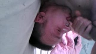 自我面部抽搐