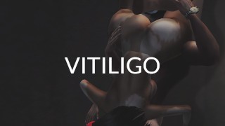 Z- Baiser un modèle avec du vitiligo - ROOM Tempête sexuelle IMVU