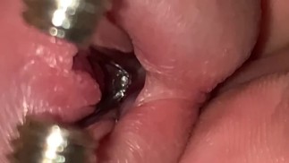 ЗОНДИРОВАНИЕ УРЕТРЫ