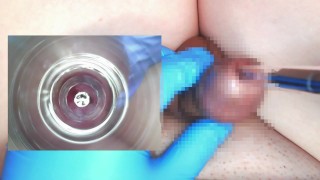 Puse un endoscopio en un tubo de ensayo de 10 mm y observé el interior de la uretra.