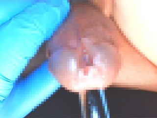 Gravação De Vídeo Da Inserção De Uma Haste De Vidro Na Uretra.