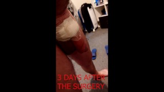 Penile Girth And Length Surgery 8495