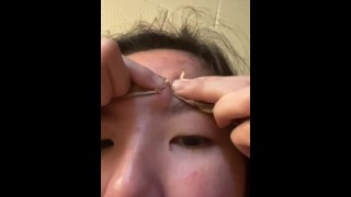 Popping Pimple