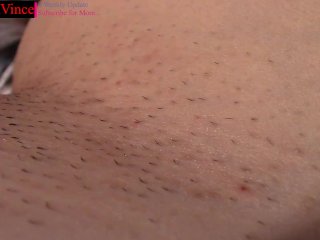 This Is My Biggest Fetish... Girls Would_You Get YYour Ingrown Hairs Removed By_Me?