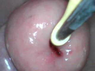 cervixplay compilation - uterus penetration and gyno_fetish