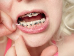 My 2nd day in braces: cleaning by dental floss
